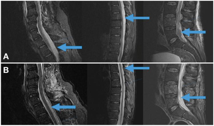 Cervical Thoracic Lumbosacral MRI